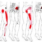  150 jpeg 9kB   , Natural Cure for Sciatica - Saigon Acupuncture Center